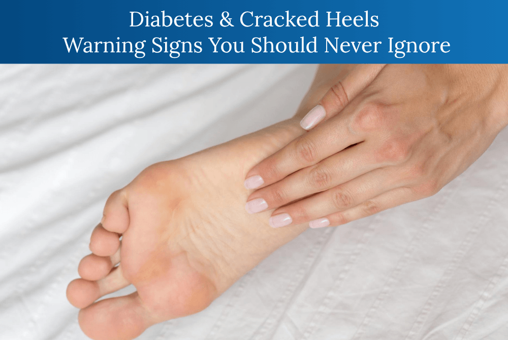 Diabetic cracked heels with dry skin and foot warning signs